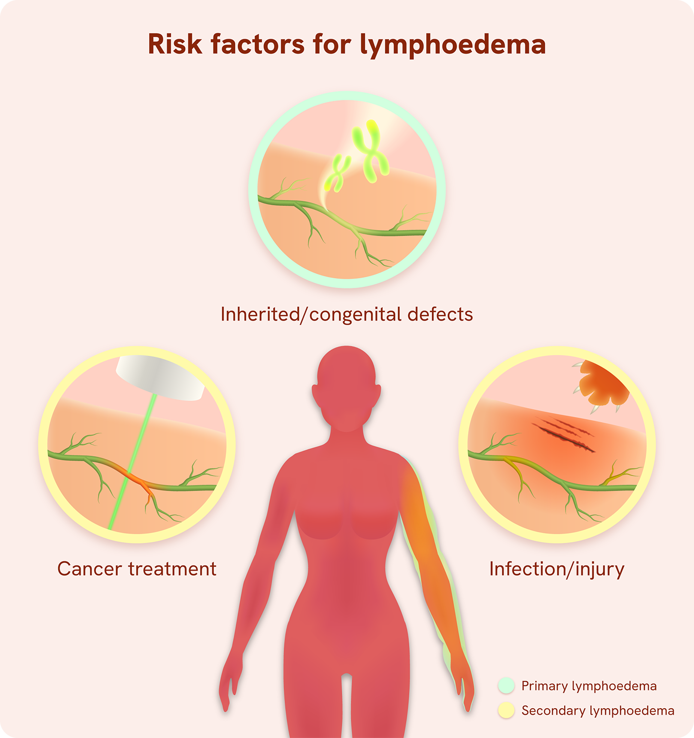 2_Lymphoedema causes