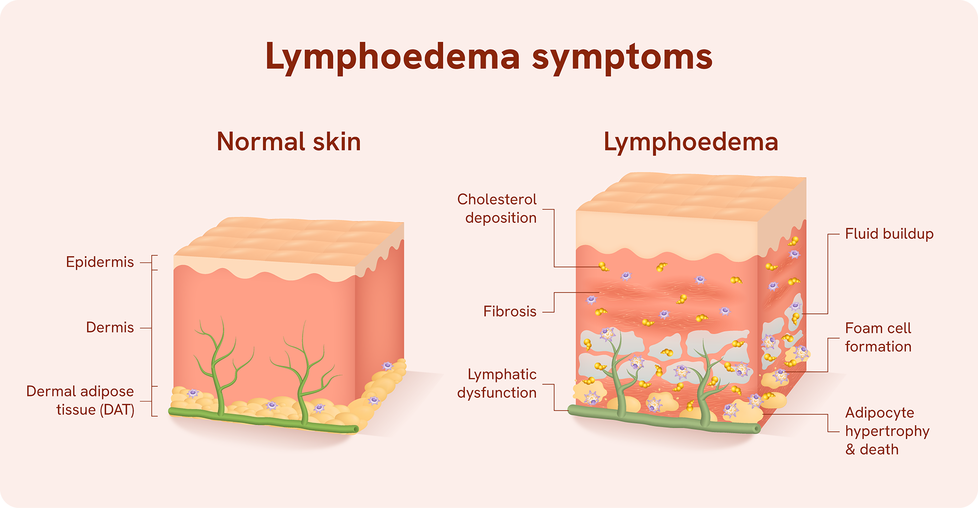 3_Lymphoedema symptoms v2 (laptop)